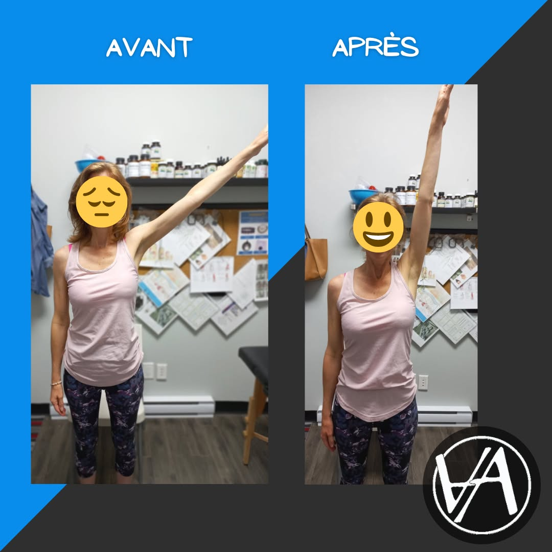 Comparaison avant et après d’une amplitude d’épaule